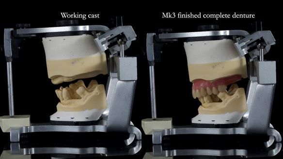 Newsletter 77: Jeremy’s case – immediate complete upper denture