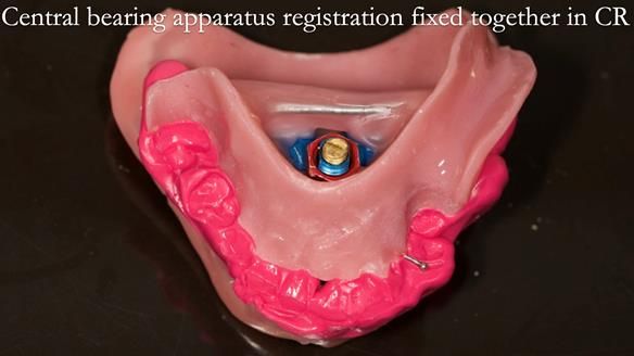 Newsletter 54 case presentation upper complete denture and lower Scandinavian designed hygienic partial denture for David