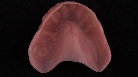 Figure 25 Mk 1 Immediate denture with thin flange