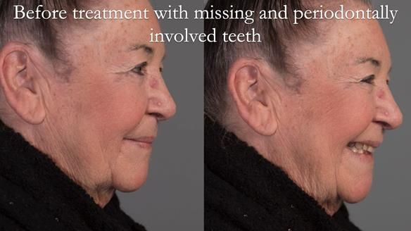 Finlay's Case Study Newsletter 40 - Immediate Mk 1 RPD to Definitive Mk 2 RPD - full protocol