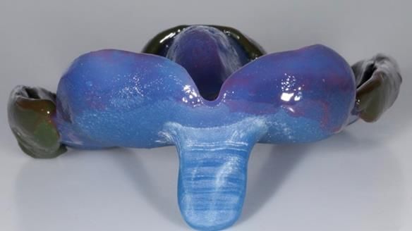 Newsletter 77: Jeremy’s case – immediate complete upper denture