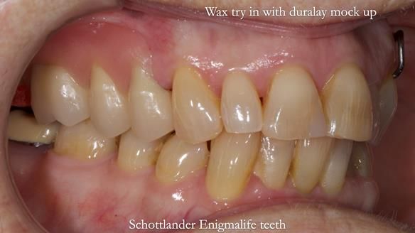 Finlay's Newsletter 60 Sylvia's upper Kennedy Class 2 Mod 1 metal based upper RPD