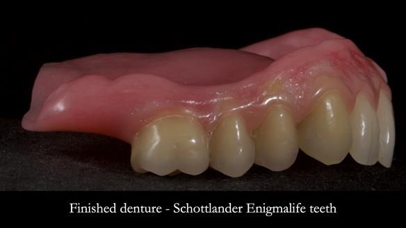 Newsletter 83: Sheila’s Complete Denture Success