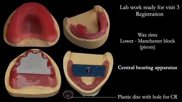 Managing poor implant positioning with complete dentures and Locator attachments - full protocol Newsletter 41