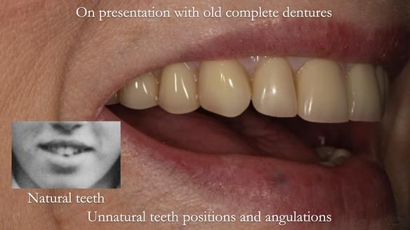 Newsletter 75: Marion’s case - Step-by-step complete denture workflow