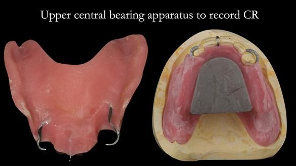 Finlay's Case Study Newsletter 40 - Immediate Mk 1 RPD to Definitive Mk 2 RPD - full protocol