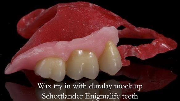 Finlay's Newsletter 64 case study - provision of a Kennedy class 2 metal based Scandinavian RPD for Ian