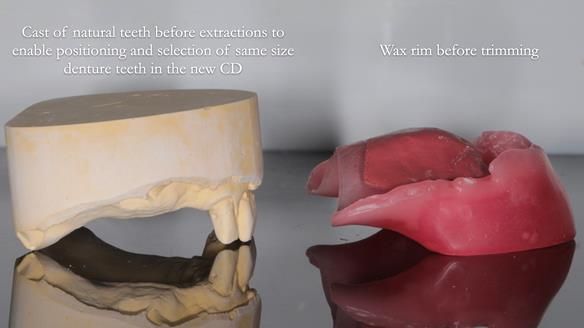 Finlay's Newsletter 62 provision of extractions and metal based complete dentures for Rafique