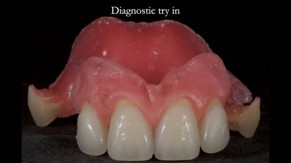 Newsletter 81 - Pam’s Story — how a partial denture changed her life (+ live walkthrough this Thursday)