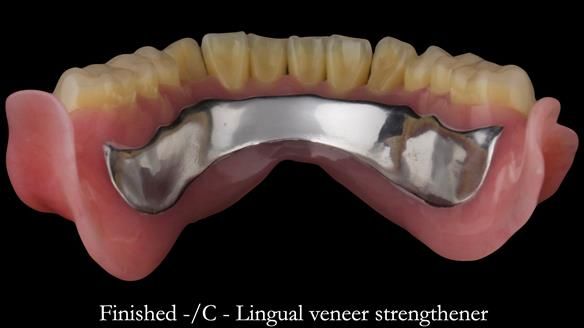 Complete denture Class II div 2 deep overbite Newsletter 39