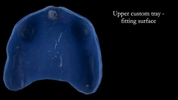 Newsletter 57 showcases the making and fitting process of implant-supported complete dentures for Alisdair