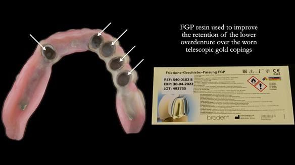 Newsletter 76: Jackie’s case – Telescopic overdenture & precision RPD (the tricky truth!)