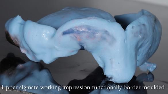 Finlay's Newsletter 58 Gasket upper partial denture for Zoe