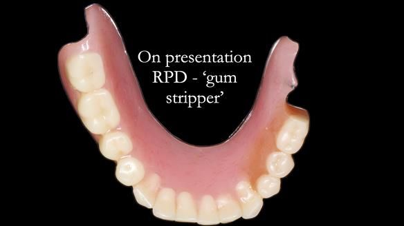 Finlay's Newsletter 59 Ultra hard partial dentures made for Gill