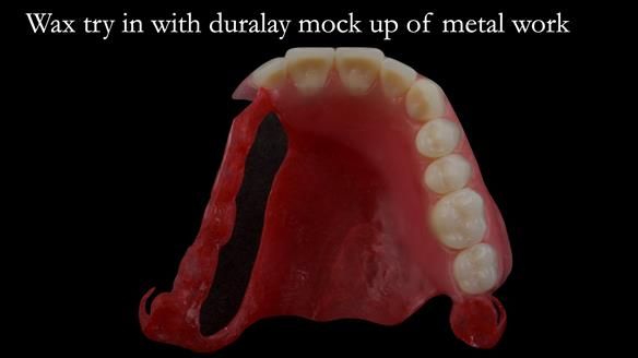 Upper metal base partial denture/occlusal stabilisation splint/obturator - full protocol
