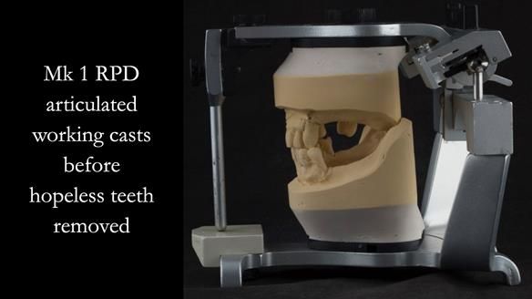 Finlay's Case Study Newsletter 40 - Immediate Mk 1 RPD to Definitive Mk 2 RPD - full protocol