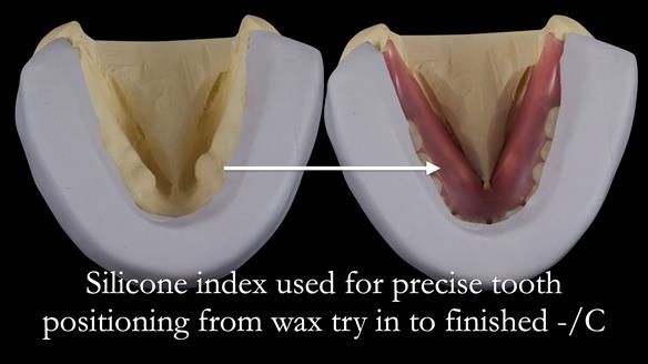 Newsletter 53 showing the making and fitting of ultra life-like dentures for Valena