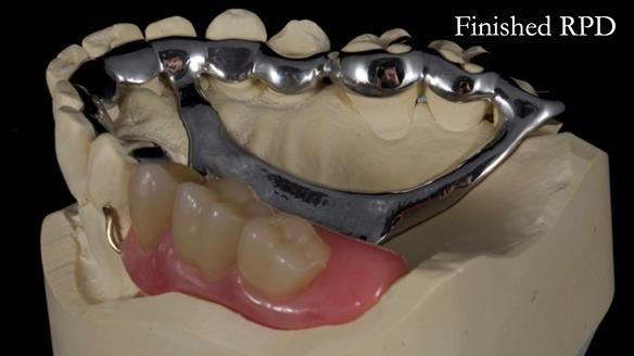 Finlay's Newsletter 64 case study - provision of a Kennedy class 2 metal based Scandinavian RPD for Ian