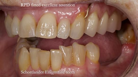 Finlay's Newsletter 60 Sylvia's upper Kennedy Class 2 Mod 1 metal based upper RPD