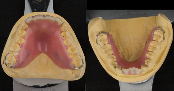 Figure 23 Finished upper and lower immediate dentures. Schottlander Enigmalife teeth