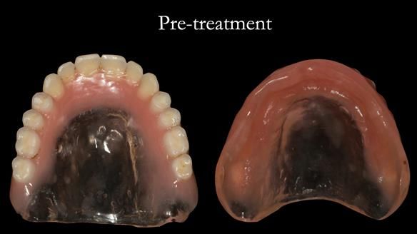 Old denture - clear palate - thick flange under base of nose - poor aesthetics