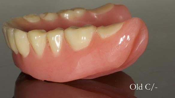 Complete denture Class II div 2 deep overbite Newsletter 39