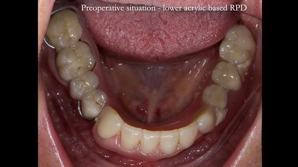 Newsletter 82 Mary - A complete upper and a one-tooth gasket denture