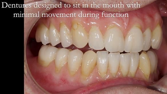 Newsletter 50 Special edition Complete Dentures FULL PROTOCOL