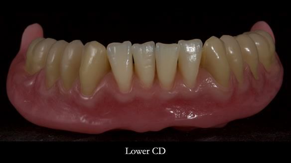 Newsletter 83: Sheila’s Complete Denture Success