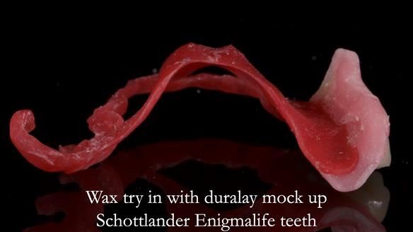 Finlay's Newsletter 64 case study - provision of a Kennedy class 2 metal based Scandinavian RPD for Ian