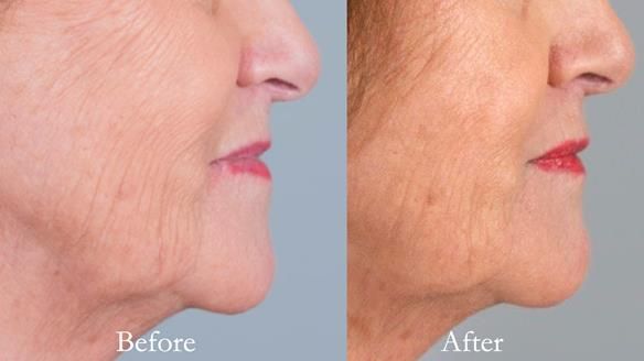 Lip support improved