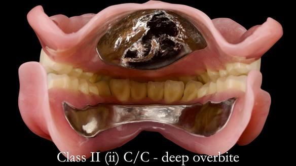 Complete denture Class II div 2 deep overbite Newsletter 39