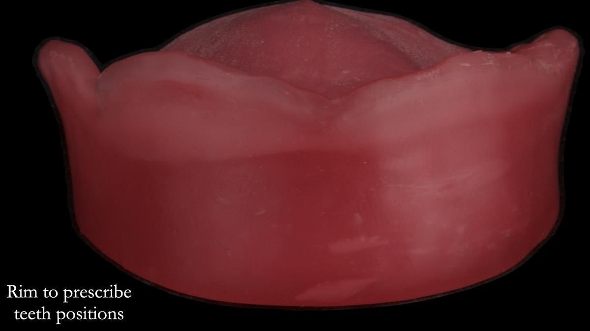 Newsletter 87 – Father Peter: A Partial Denture that needed Minor Miracle