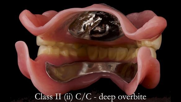 Complete denture Class II div 2 deep overbite Newsletter 39