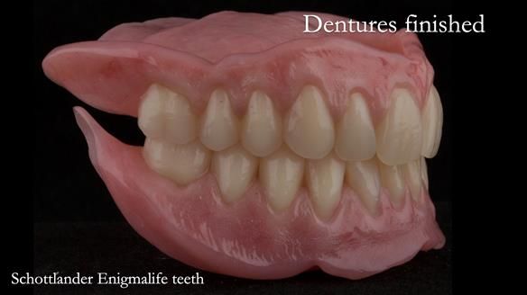 Newsletter 75: Marion’s case - Step-by-step complete denture workflow
