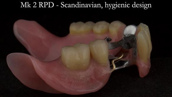 Finlay's Case Study Newsletter 40 - Immediate Mk 1 RPD to Definitive Mk 2 RPD - full protocol