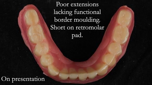 Finlay's Newsletter 62 provision of extractions and metal based complete dentures for Rafique