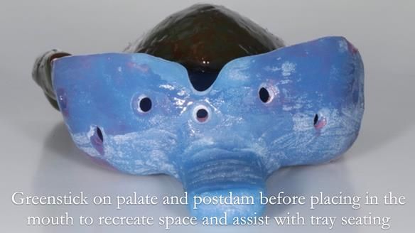 Newsletter 56 showing the making and fitting of a bilateral free end saddle upper removable partial denture (RPD) for patient with pemphigus