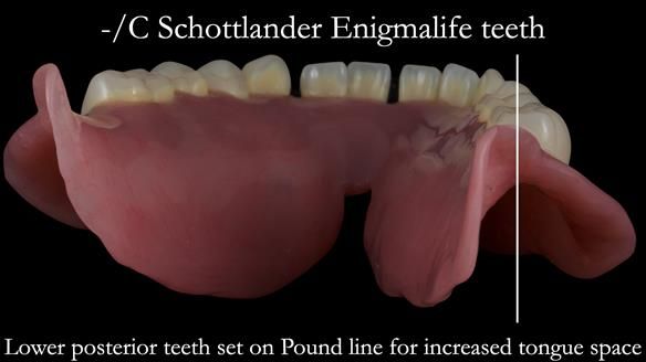 Newsletter 53 showing the making and fitting of ultra life-like dentures for Valena