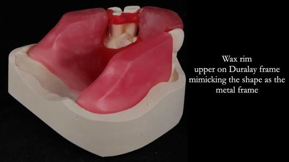 Finlay's Newsletter 59 Ultra hard partial dentures made for Gill