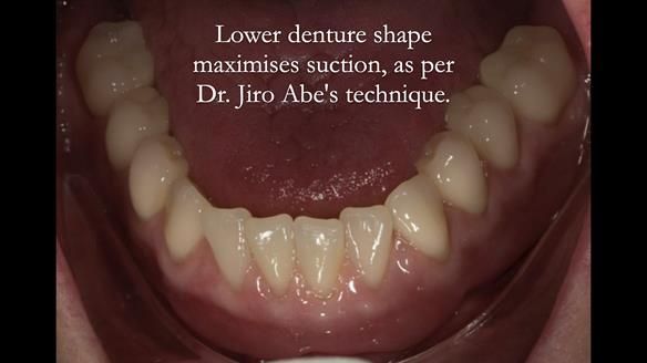 Newsletter 75: Marion’s case - Step-by-step complete denture workflow