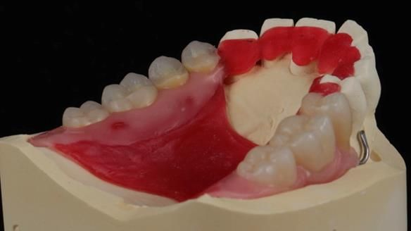Newsletter 56 showing the making and fitting of a bilateral free end saddle upper removable partial denture (RPD) for patient with pemphigus