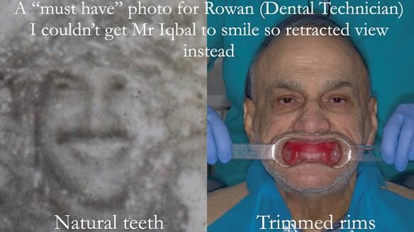 Managing poor implant positioning with complete dentures and Locator attachments - full protocol Newsletter 41