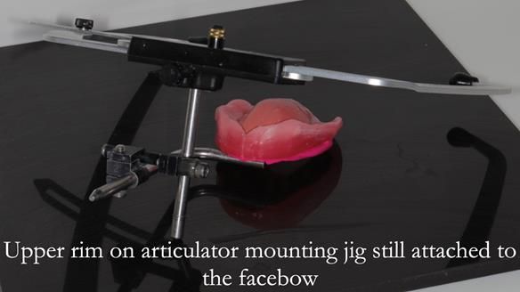 Newsletter 53 showing the making and fitting of ultra life-like dentures for Valena