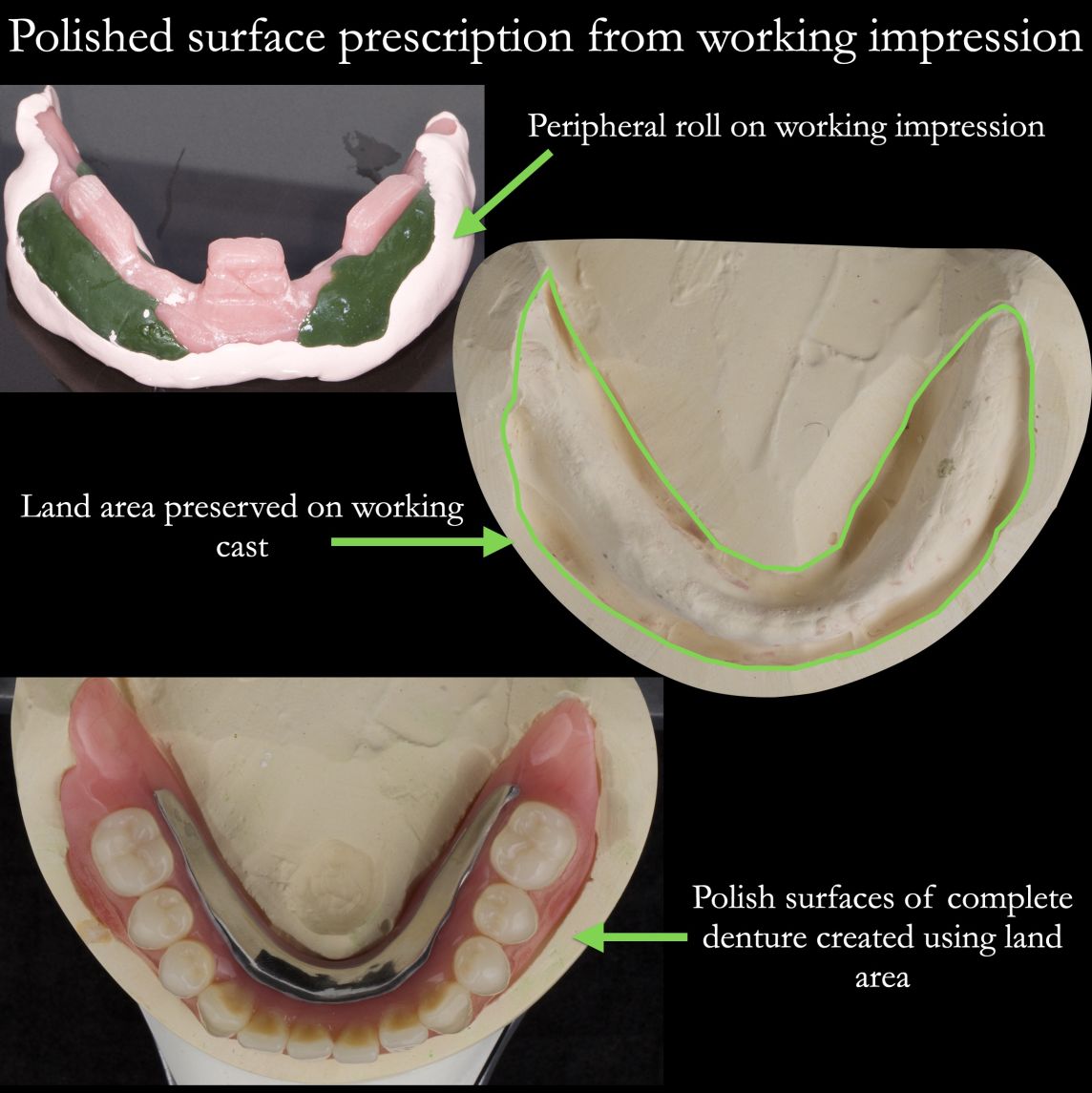Preserving land area for complete dentures and free end saddles