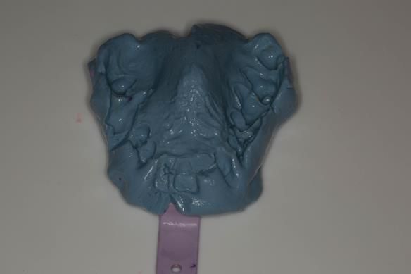 Figure 13 Maxillary stock tray impression made in alginate (Dentsply Blueprint) recording the palate, palatal and occlusal surfaces of the teeth. I didn't want to extract the teeth in the impression - stage 1