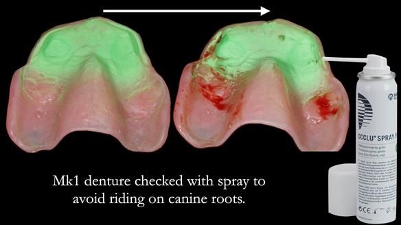 Newsletter 77: Jeremy’s case – immediate complete upper denture