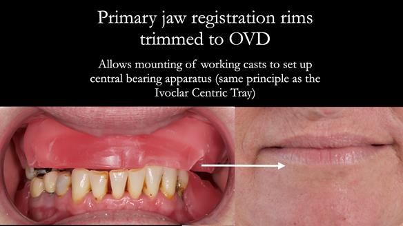 Newsletter 52 Managing Jo’s failing dentition with extractions and Mk 1/Mk 2 complete upper dentures and lower partial dentures FULL PROTOCOL