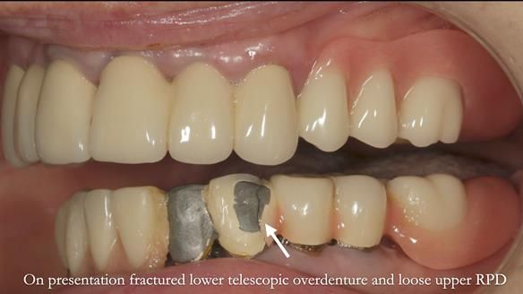Newsletter 76: Jackie’s case – Telescopic overdenture & precision RPD (the tricky truth!)