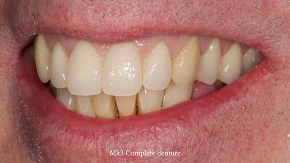 Newsletter 77: Jeremy’s case – immediate complete upper denture